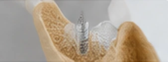 Knochenaufbau
